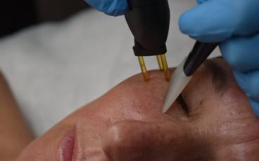 Neogen Stikstof plasma